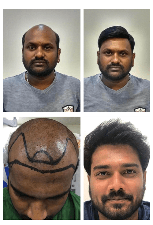 best hair transplant clinic Bangalore, hair transplant Bangalore, hair restoration, hair treatments, hair loss solutions, hair growth clinic, advanced hair care, hair rejuvenation, hair thinning treatment, Sparha hair clinic