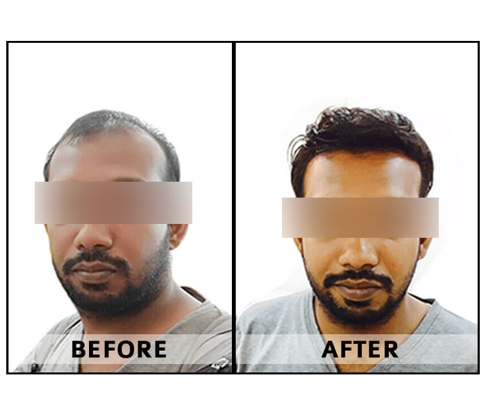 best hair transplant clinic Bangalore, hair transplant Bangalore, hair restoration, hair treatments, hair loss solutions, hair growth clinic, advanced hair care, hair rejuvenation, hair thinning treatment, Sparha hair clinic